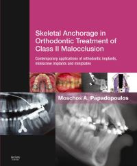 Cover image: Skeletal Anchorage in Orthodontic Treatment of Class II Malocclusion: Contemporary Applications of Orthodontic Implants, Miniscrew Implants and Mini Pl 1st edition 9780723436492