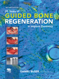 Imagen de portada: 20 Years of Guided Bone Regeneration in Implant Dentistry, Second Edition 2nd edition 9780867154016