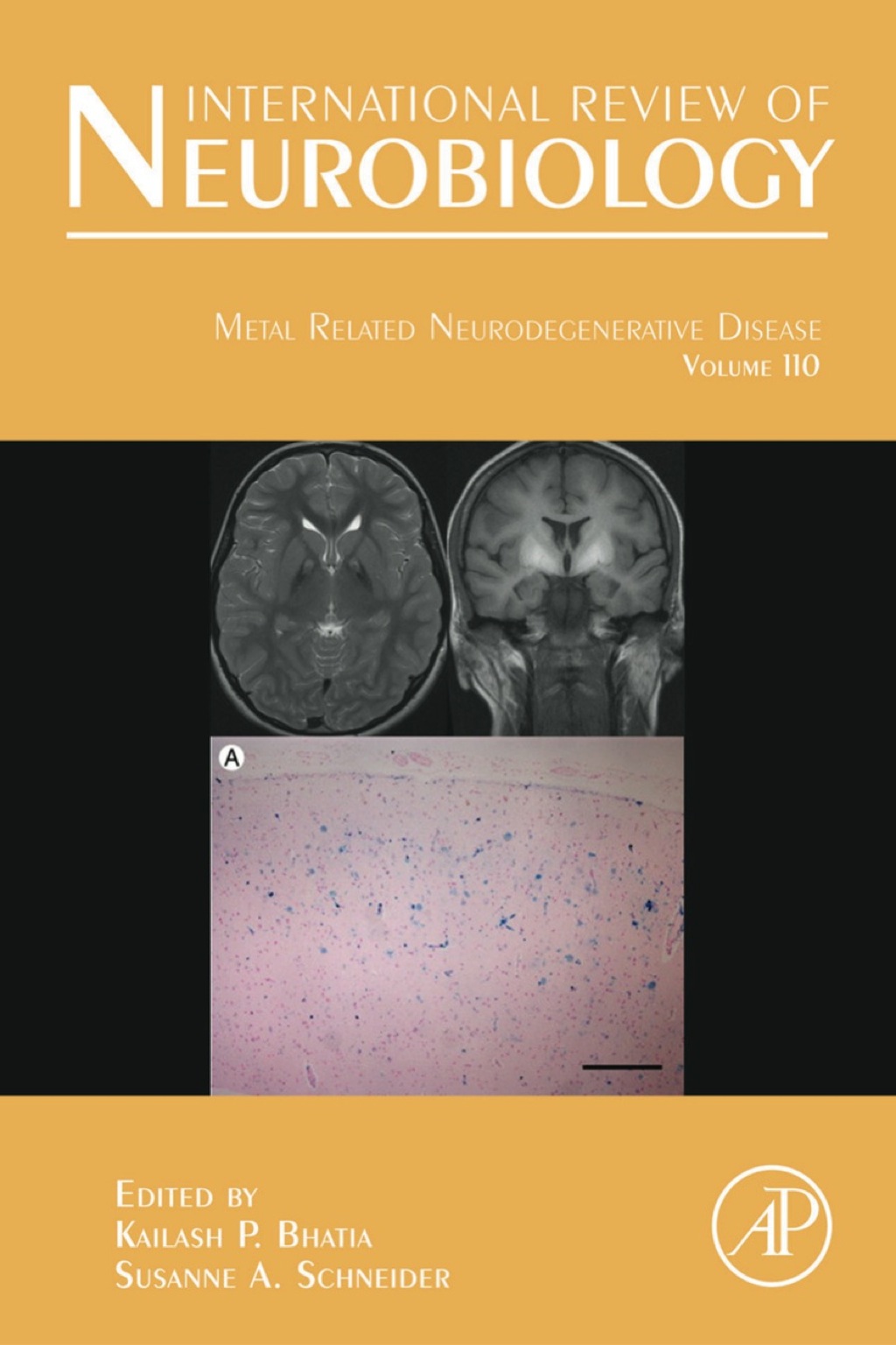 Metal Related Neurodegenerative Disease