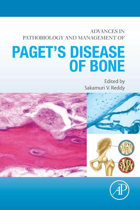 Advances in Pathobiology and Management of Paget’s Disease of Bone - FULL INSTANT DOWNLOAD | PDF DOCX EPUB