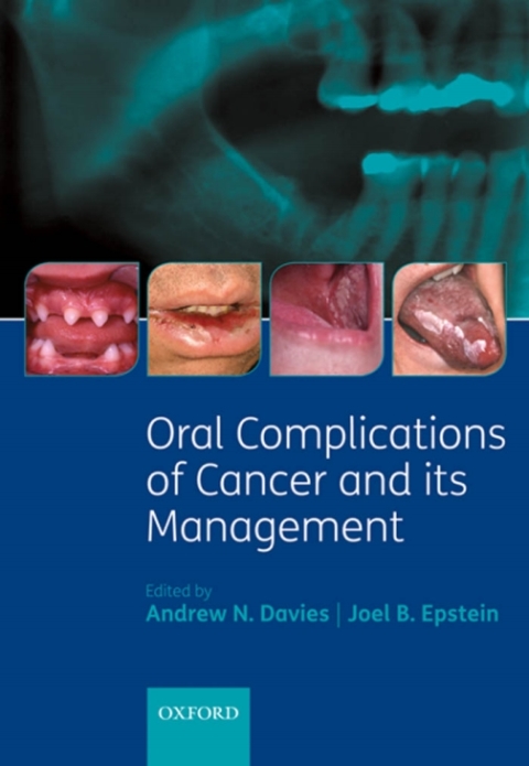Oral Complications of Cancer and its Management, 1st Edition - FULL INSTANT DOWNLOAD | PDF DOCX EPUB