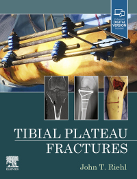 Titelbild: Tibial Plateau Fractures - E-Book 9780323825689