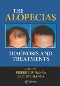 Cover image: The Alopecias 1st edition 9781482212754