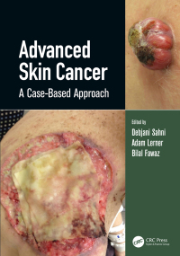 Cover image: Advanced Skin Cancer 1st edition 9780367134716