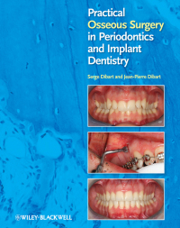 Cover image: Practical Osseous Surgery in Periodontics and Implant Dentistry 1st edition 9780813818122