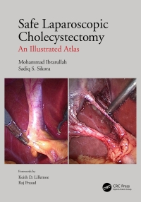 Cover image: Safe Laparoscopic Cholecystectomy 1st edition 9781032277660