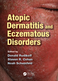 Imagen de portada: Atopic Dermatitis and Eczematous Disorders 1st edition 9780367537685