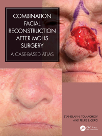 Imagen de portada: Combination Facial Reconstruction after Mohs Surgery 1st edition 9781032509372