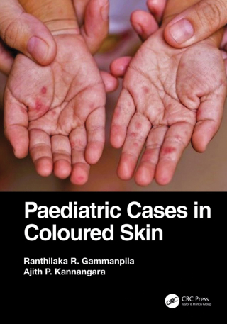 Cover image: Paediatric Cases in Coloured Skin 1st edition 9781032343150