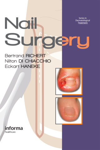 Imagen de portada: Nail Surgery 1st edition 9780415472333