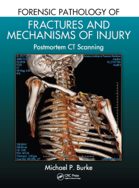 صورة الغلاف: Forensic Pathology of Fractures and Mechanisms of Injury 1st edition 9781439881484