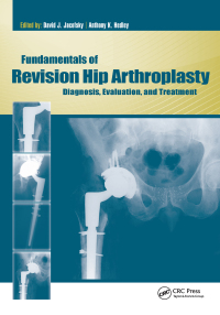 Imagen de portada: Fundamentals of Revision Hip Arthroplasty 1st edition 9781556429521