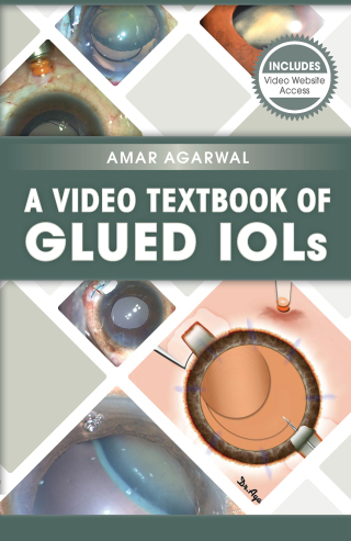Immagine di copertina: A Video Textbook of Glued IOLs 1st edition 9781630912246