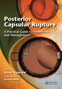 Cover image: Posterior Capsular Rupture 1st edition 9781617110719