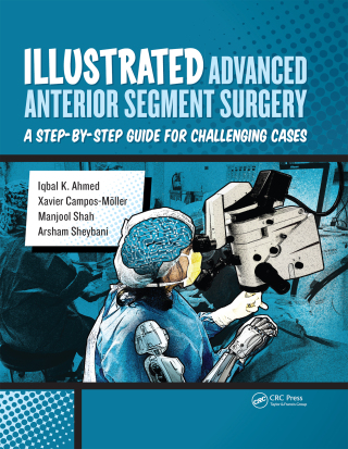 Cover image: Illustrated Advanced Anterior Segment Surgery 1st edition 9781630911843