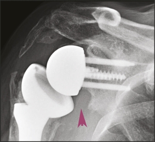 Cover image: Reverse Shoulder Arthroplasty 1st edition 9781630916855