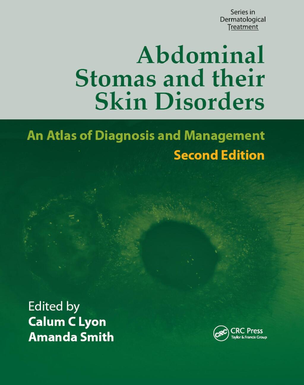 Abdominal Stomas and Their Skin Disorders 2nd Edition