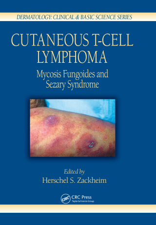 Cover image: Cutaneous T-Cell Lymphoma 1st edition 9780367393670