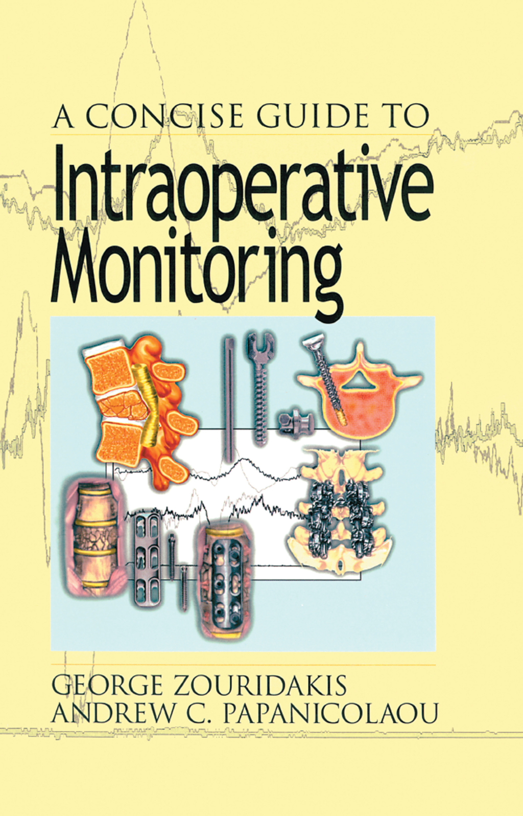 A Concise Guide to Intraoperative Monitoring 1st Edition
