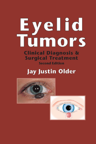 Cover image: Eyelid Tumors 2nd edition 9781840760293