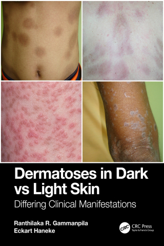 Cover image: Dermatoses in Dark Vs Light Skin 1st edition 9781032762739