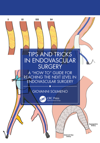 Cover image: Tips and Tricks in Endovascular Surgery 1st edition 9781032936710