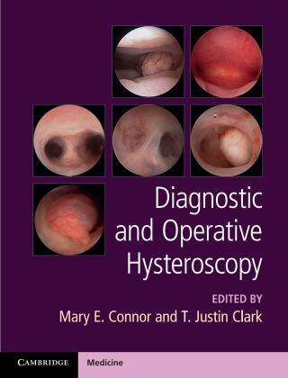 Cover image: Diagnostic and Operative Hysteroscopy 1st edition 9781107111608