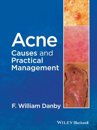Cover image: Acne 1st edition 9781118232774