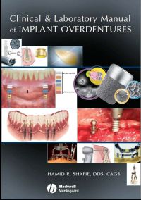 Cover image: Clinical and Laboratory Manual of Implant Overdentures 1st edition 9780813808819