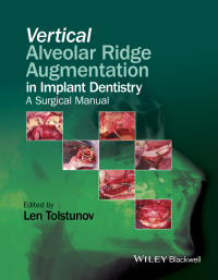 صورة الغلاف: Vertical Alveolar Ridge Augmentation in Implant Dentistry 1st edition 9781119082590