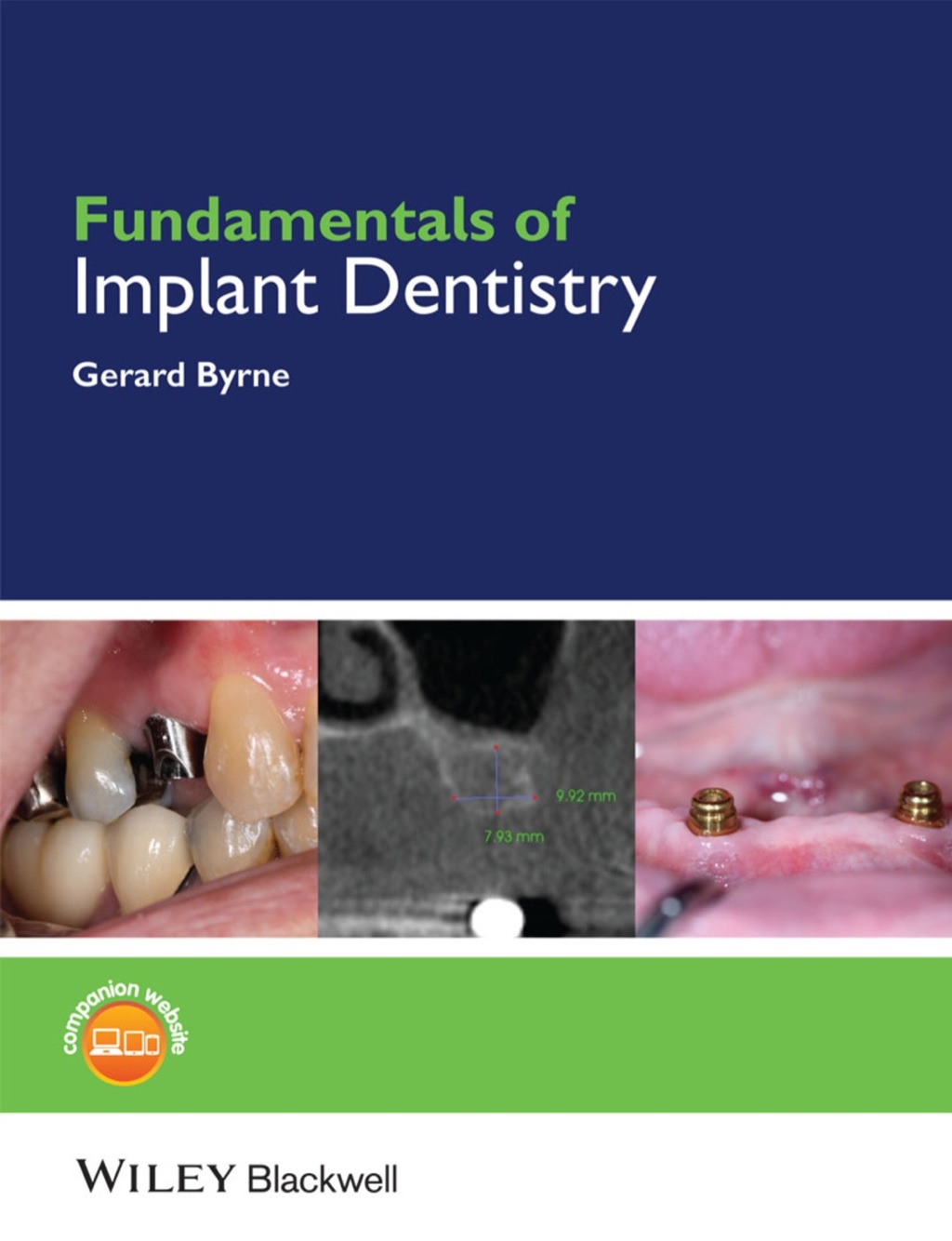 Fundamentals of Implant Dentistry 1st Edition
