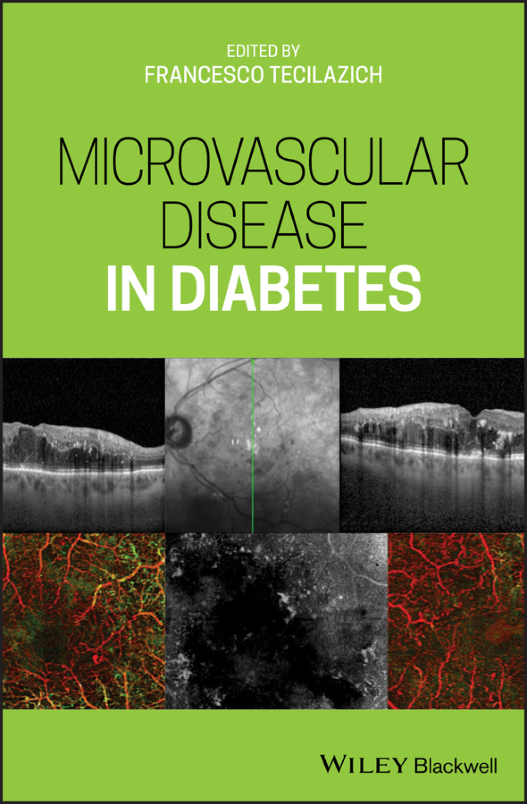 Microvascular Disease in Diabetes 1st Edition