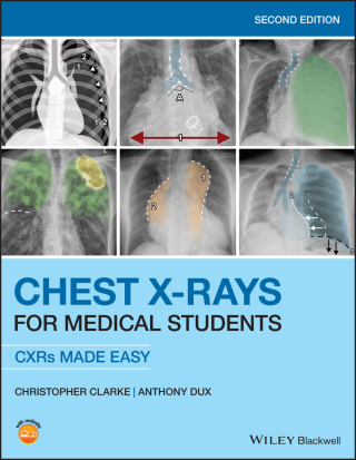 Immagine di copertina: Chest X-Rays for Medical Students 2nd edition 9781119504153