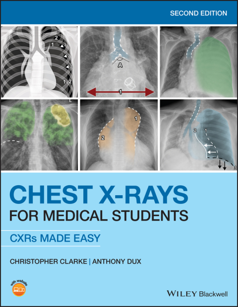 Chest X-Rays for Medical Students, 2nd Edition - FULL INSTANT DOWNLOAD | PDF DOCX EPUB