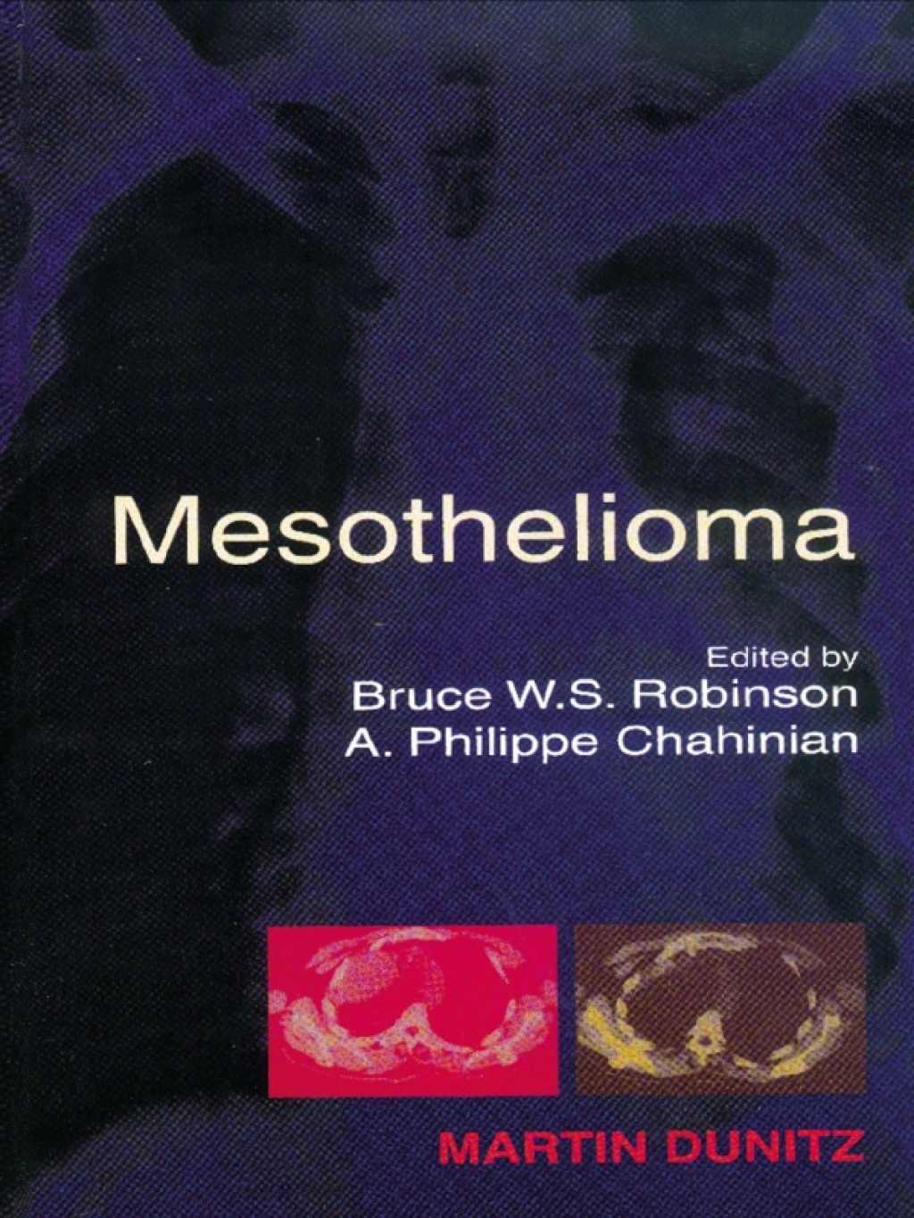 Mesothelioma 1st Edition