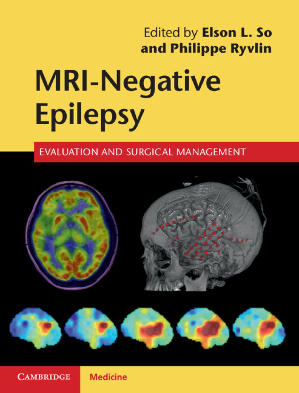 MRI-Negative Epilepsy Evaluation and Surgical Management 1st Edition