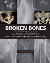 表紙画像: Broken Bones 2nd edition 9781107499232