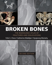 Titelbild: Broken Bones 2nd edition 9781107499232