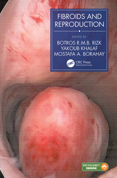 Fibroids and Reproduction, 1st Edition - FULL INSTANT DOWNLOAD | PDF DOCX EPUB