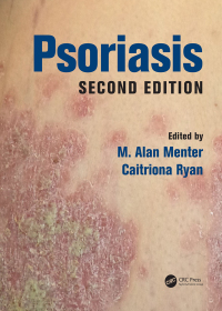 Omslagafbeelding: Psoriasis 2nd edition 9781498700528