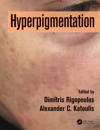 Cover image: Hyperpigmentation 1st edition 9781138582996