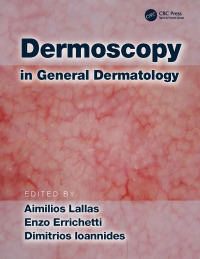 Omslagafbeelding: Dermoscopy in General Dermatology 1st edition 9781138706569