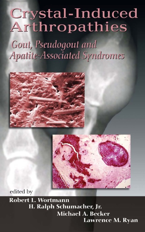 Crystal-Induced Arthropathies : Gout, Pseudogout and Apatite-Associated Syndromes, 1st Edition - FULL INSTANT DOWNLOAD | PDF DOCX EPUB