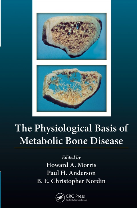 The Physiological Basis of Metabolic Bone Disease, 1st Edition - FULL INSTANT DOWNLOAD | PDF DOCX EPUB