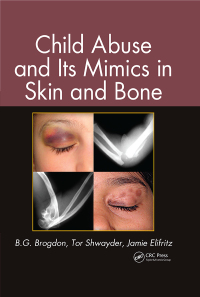 Titelbild: Child Abuse and its Mimics in Skin and Bone 1st edition 9780367778187