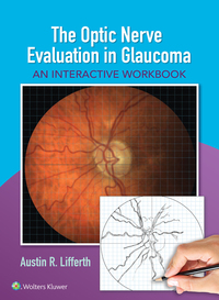 Cover image: The Optic Nerve Evaluation in Glaucoma 9781496343550