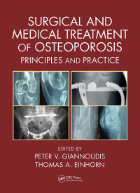 Cover image: Surgical and Medical Treatment of Osteoporosis 1st edition 9781498732246