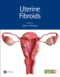 Cover image: Uterine Fibroids 1st edition 9781498739207