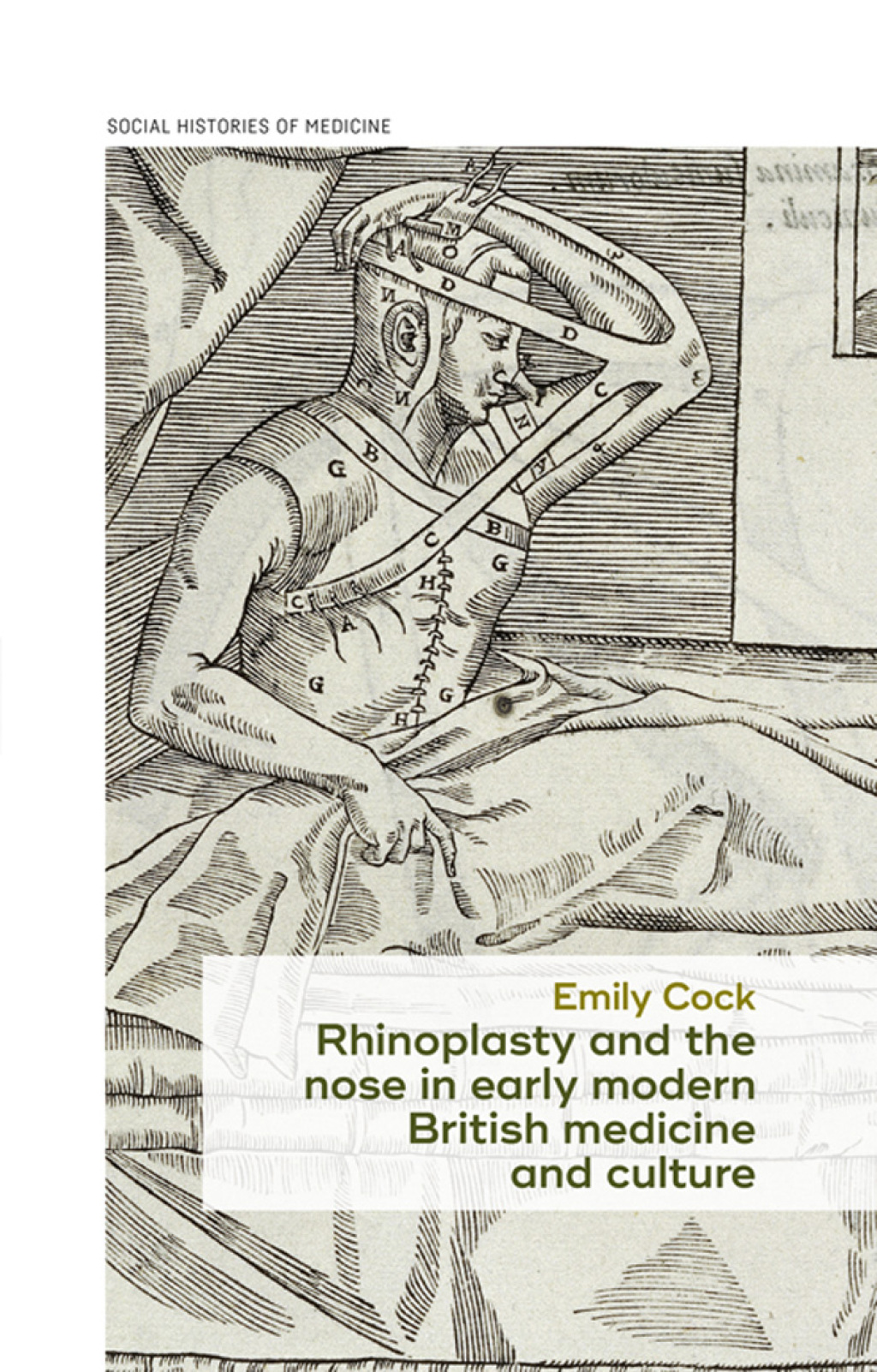 Rhinoplasty and the nose in early modern British medicine and culture 1st Edition