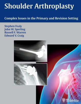 Cover image: Shoulder Arthroplasty 1st edition 9781588905055